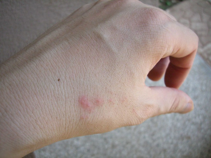 Bed bug bites