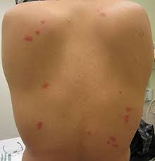 Bed bug bites on a person's back