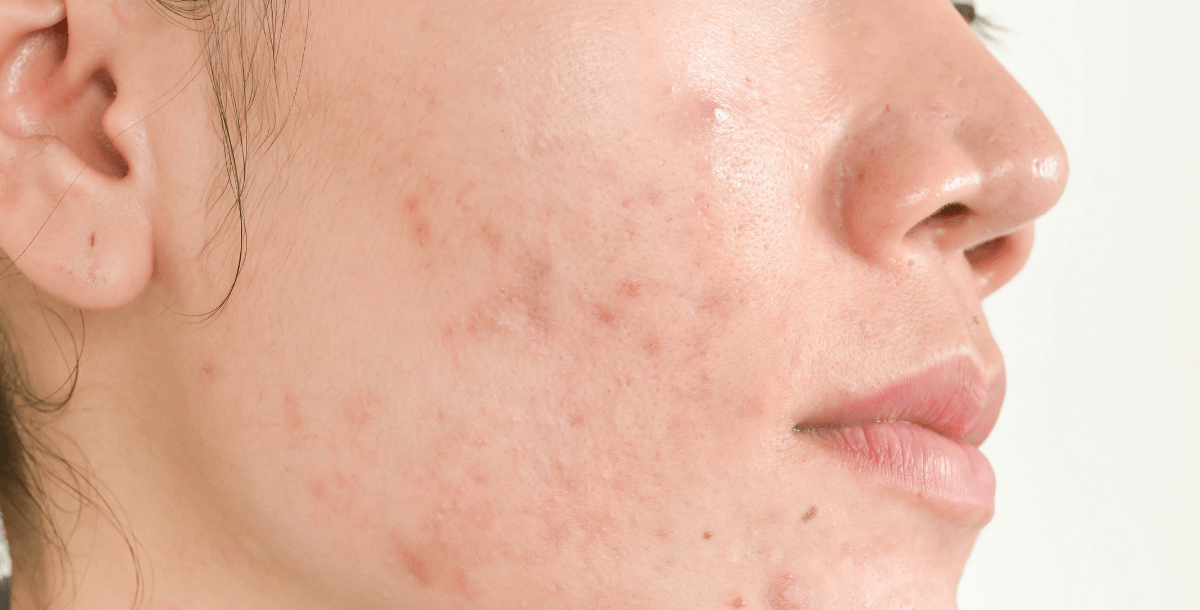 Poor quality sleep can cause skin breakouts suc as acne