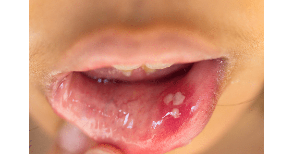 Mouth ulcers