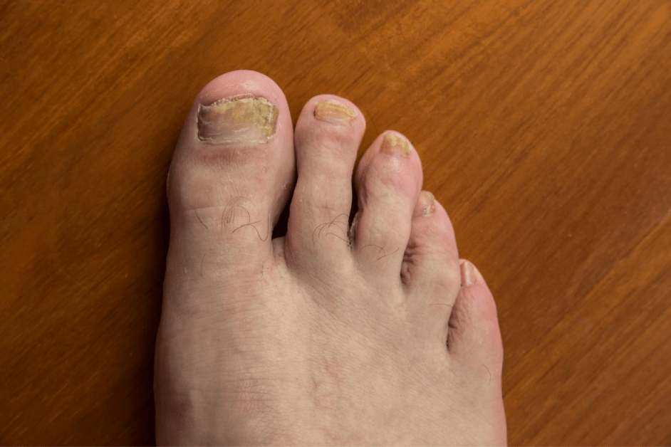 Home Remedies for Nail Fungus