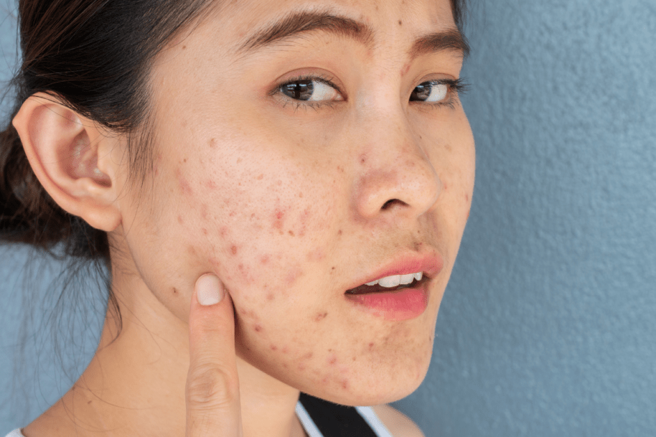 Woman with acne