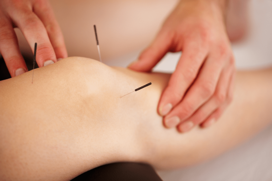 Acupuncture For Pain Relief