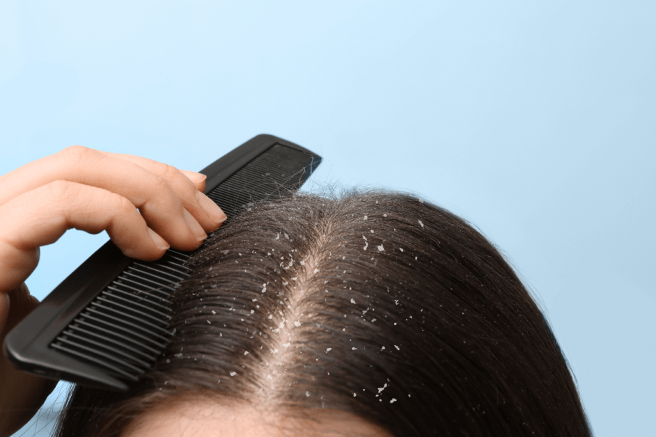 Get Rid of Dandruff On Your Hair